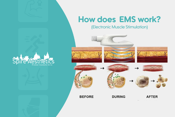 EMS treatment for post pregnancy weight loss treatment Warrington