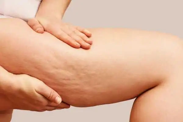 Image of woman showing leg with cellulite Warrington