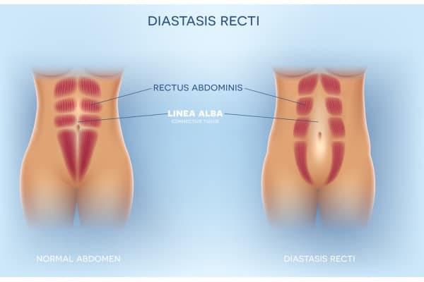 What Non-Surgical Options Are Available for Diastasis Recti Warrington?