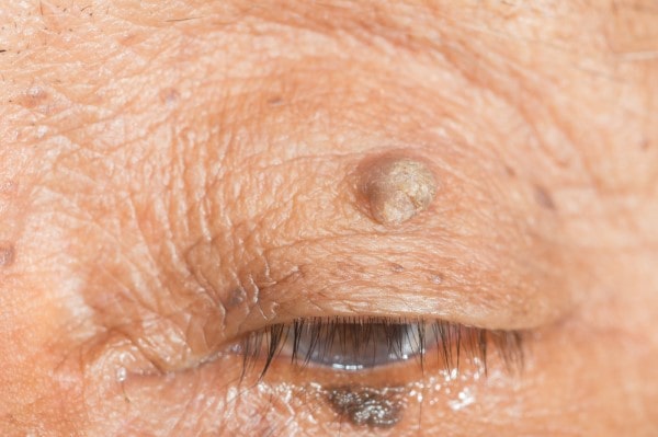 Skin imperfections Warrington - Cryopen is fast and effective book in today!