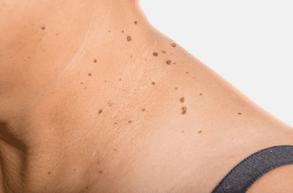 Are you looking for easy skin tag removal Warrington - then contact Spire today!