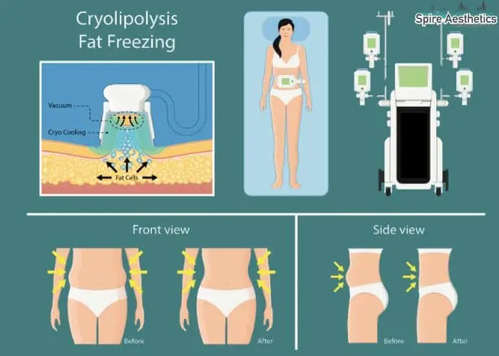 Fat freezing treatment Warrington benefits for competitions to remove stubborn fat deposits.