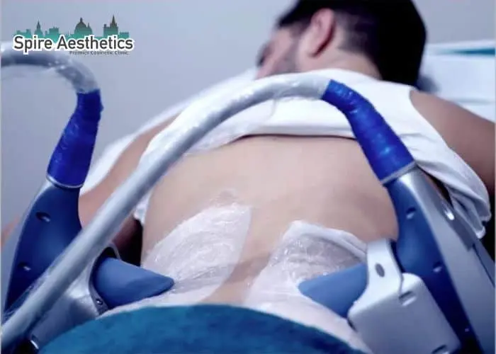 Man having fat freezing treatment done on love handles before a competitions Warrington to create a sculpted look.
