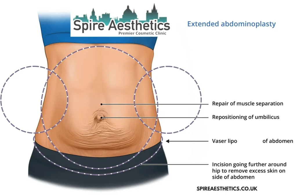 Understanding Loose Skin After Gastric Band Warrington Surgery and HIFU Treatment
