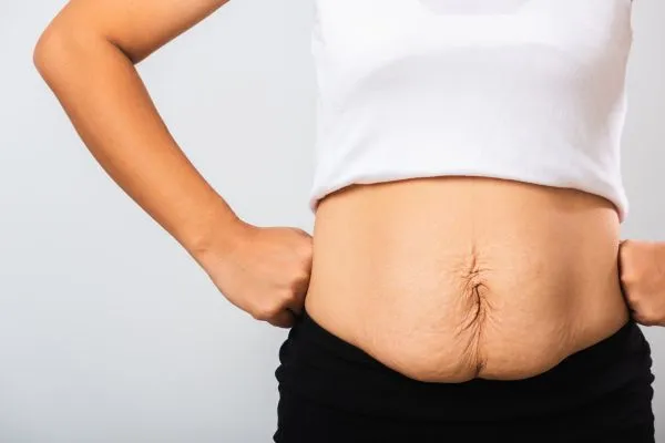Image of a woman's stomach after weight loss with sagging skin following a gastric band Warrington