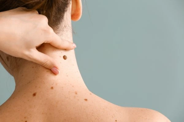 skin blemish removal Warrington treatment