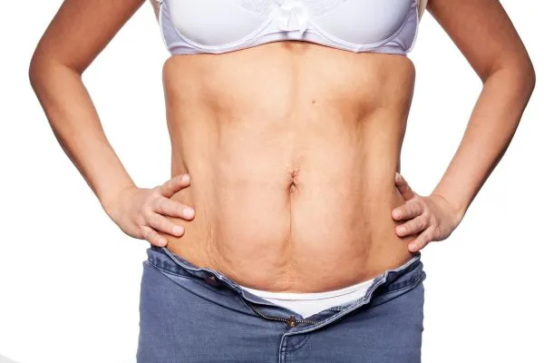 sagging skin on woman's stomach after weight loss injections Warrington