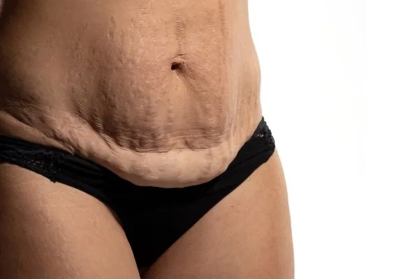 Image of womans stomach after weight loss injections Warrington showing saggy skin