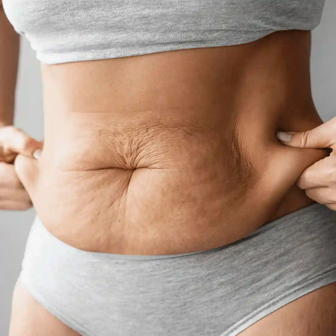 Is It Normal to Have Loose Skin After Pregnancy Warrington?