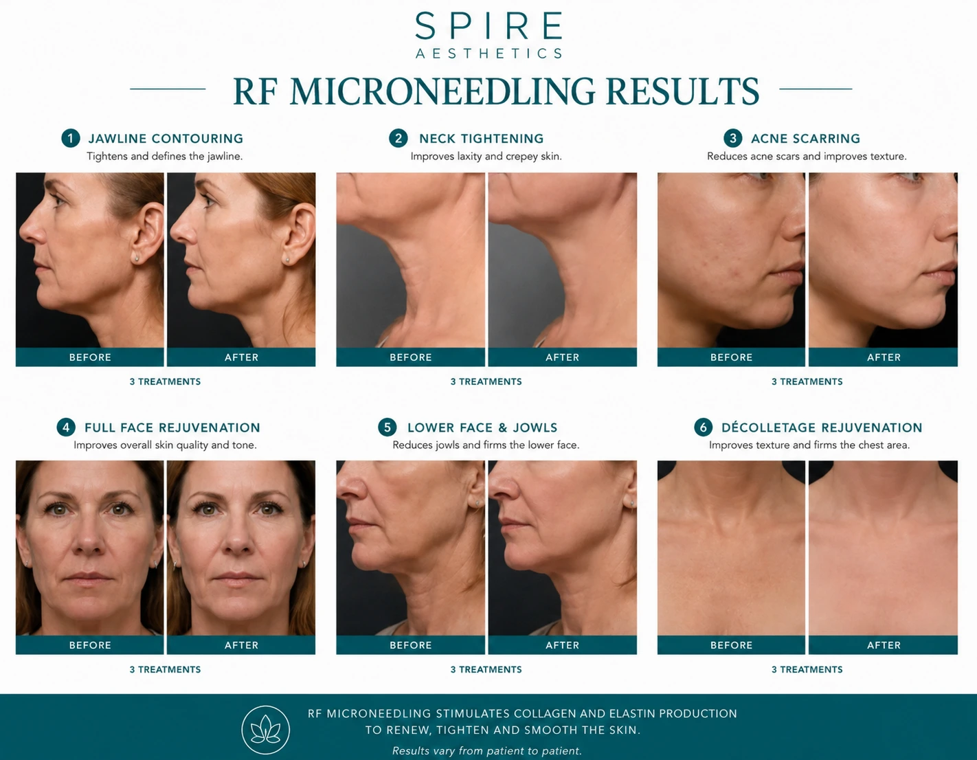 RF Microneedling Skin tightening Warrington results