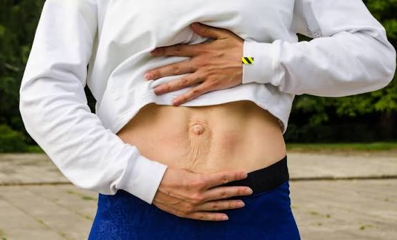 When Could Diastasis Recti Be the Missing Piece of the Puzzle Warrington?