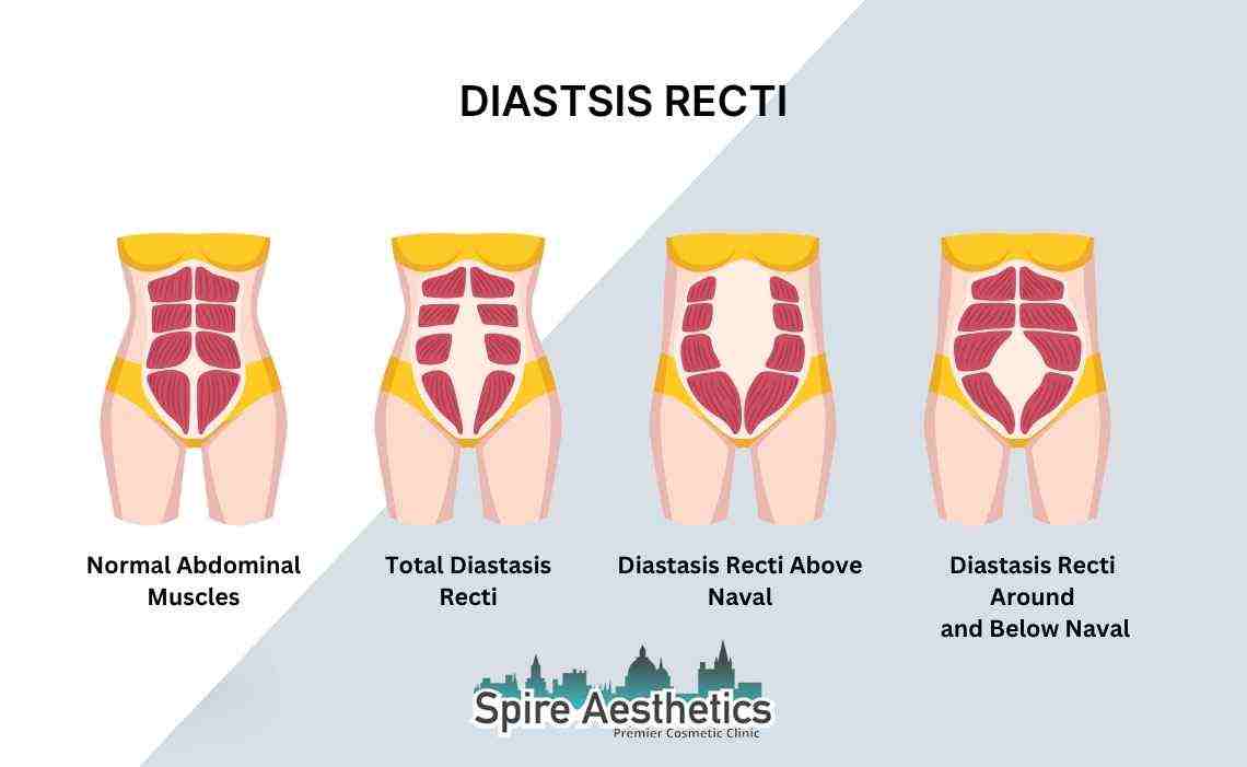 Is Non-Surgical Diastasis Recti Treatment Right for You? Common Concerns Answered Warrington